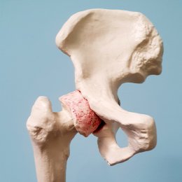 Koxartróza (artróza kyčelního kloubu)