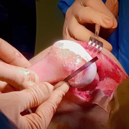 Úspěšná transplantace "poloviny kolene"